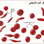 About Thalassemia And Sickle Cell Anemia(4)